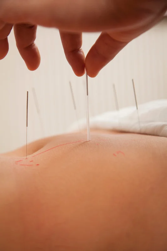 acupuncture