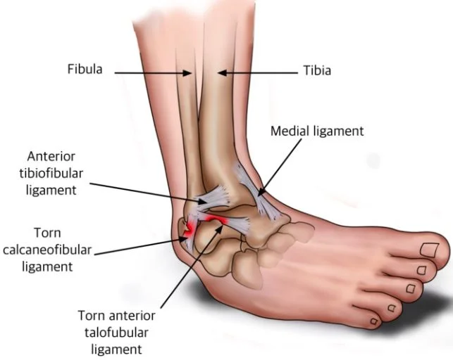 ankle-sprains
