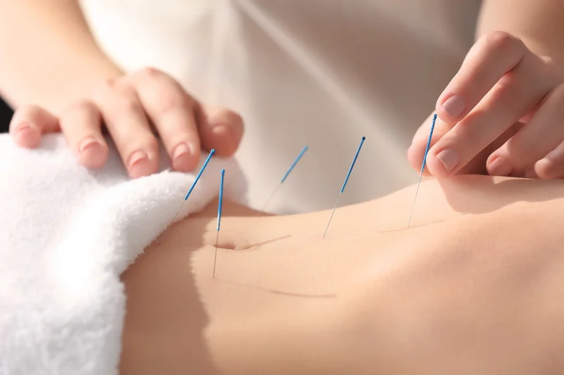 Intramuscular stimulation (IMS) treatment at Ottawa Physiotherapy and Sport Clinics